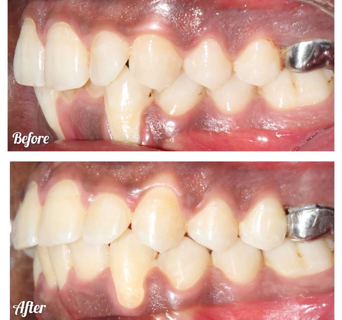Deep Bite & Lateral Occlusion - Before & After Clinical Result